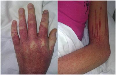 Case report: Sulfasalazine-induced hypersensitivity